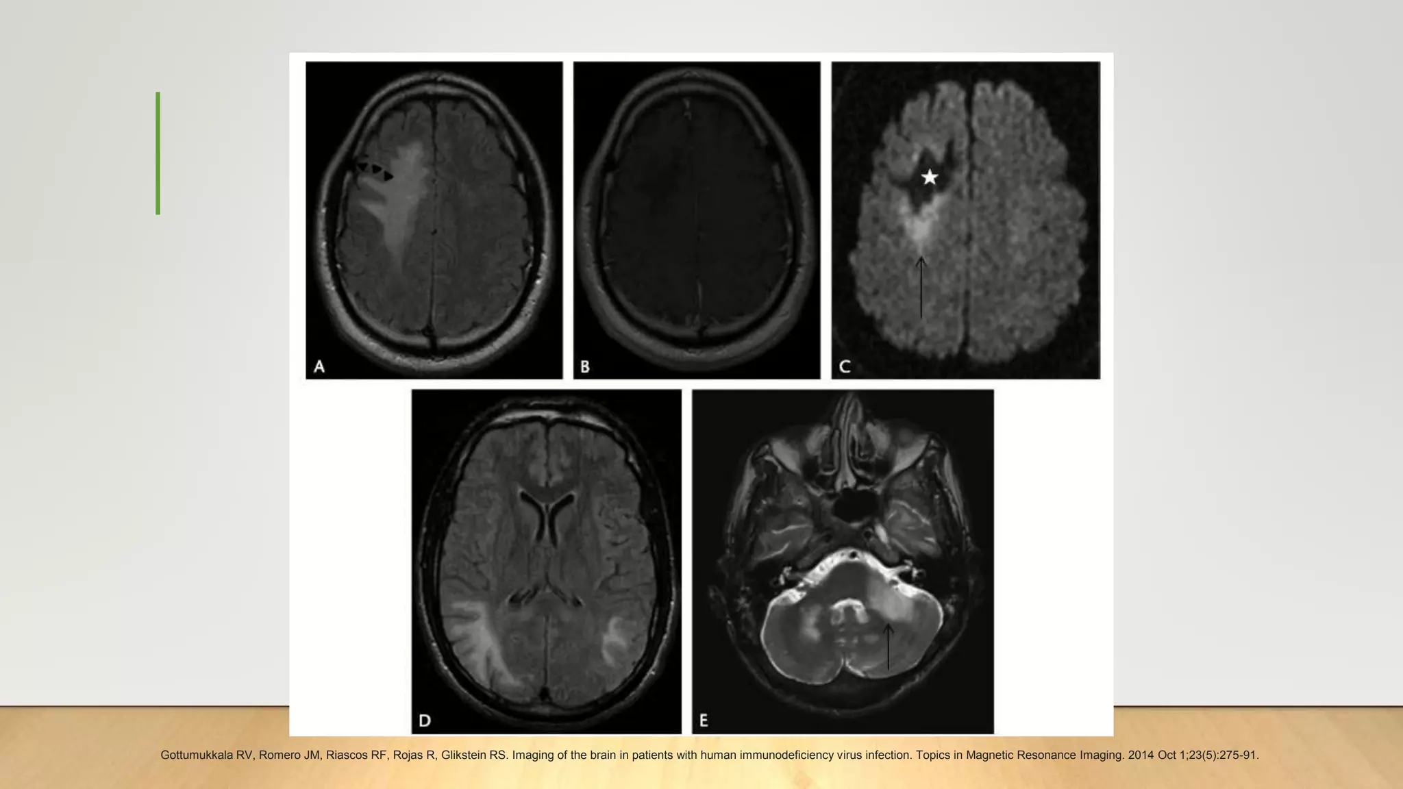 Gottumukkala RV, Romero JM, Riascos RF, Rojas R, Glikstein RS. Imaging of the brain in patients with human immunodeficiency virus infection. Topics in Magnetic Resonance Imaging. 2014 Oct 1;23(5):275-91.
 