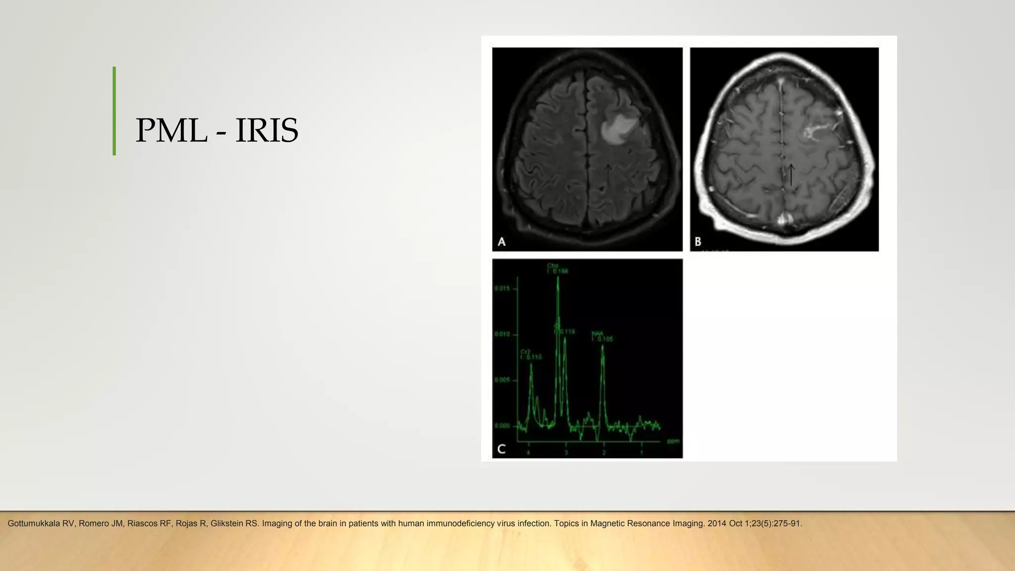 PML - IRIS
Gottumukkala RV, Romero JM, Riascos RF, Rojas R, Glikstein RS. Imaging of the brain in patients with human immunodeficiency virus infection. Topics in Magnetic Resonance Imaging. 2014 Oct 1;23(5):275-91.
 