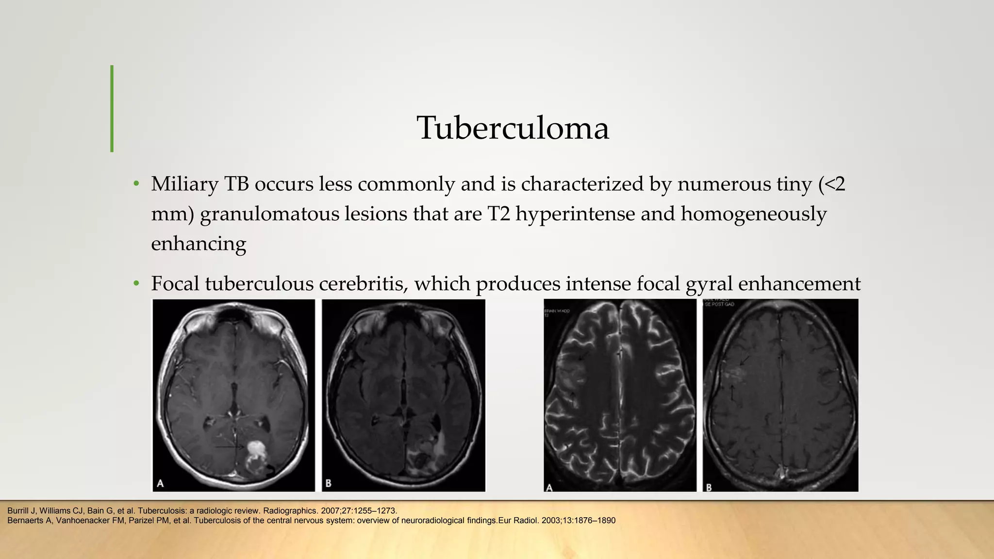 Tuberculoma
• Miliary TB occurs less commonly and is characterized by numerous tiny (<2
mm) granulomatous lesions that are T2 hyperintense and homogeneously
enhancing
• Focal tuberculous cerebritis, which produces intense focal gyral enhancement
Burrill J, Williams CJ, Bain G, et al. Tuberculosis: a radiologic review. Radiographics. 2007;27:1255–1273.
Bernaerts A, Vanhoenacker FM, Parizel PM, et al. Tuberculosis of the central nervous system: overview of neuroradiological findings.Eur Radiol. 2003;13:1876–1890
 
