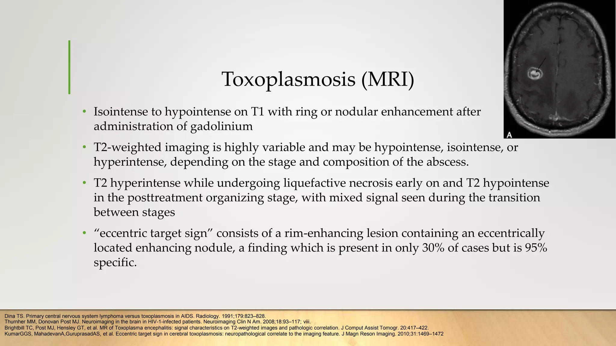 Toxoplasmosis (MRI)
• Isointense to hypointense on T1 with ring or nodular enhancement after
administration of gadolinium
• T2-weighted imaging is highly variable and may be hypointense, isointense, or
hyperintense, depending on the stage and composition of the abscess.
• T2 hyperintense while undergoing liquefactive necrosis early on and T2 hypointense
in the posttreatment organizing stage, with mixed signal seen during the transition
between stages
• “eccentric target sign” consists of a rim-enhancing lesion containing an eccentrically
located enhancing nodule, a finding which is present in only 30% of cases but is 95%
specific.
Dina TS. Primary central nervous system lymphoma versus toxoplasmosis in AIDS. Radiology. 1991;179:823–828.
Thurnher MM, Donovan Post MJ. Neuroimaging in the brain in HIV-1-infected patients. Neuroimaging Clin N Am. 2008;18:93–117; viii.
Brightbill TC, Post MJ, Hensley GT, et al. MR of Toxoplasma encephalitis: signal characteristics on T2-weighted images and pathologic correlation. J Comput Assist Tomogr. 20:417–422.
KumarGGS, MahadevanA,GuruprasadAS, et al. Eccentric target sign in cerebral toxoplasmosis: neuropathological correlate to the imaging feature. J Magn Reson Imaging. 2010;31:1469–1472
 
