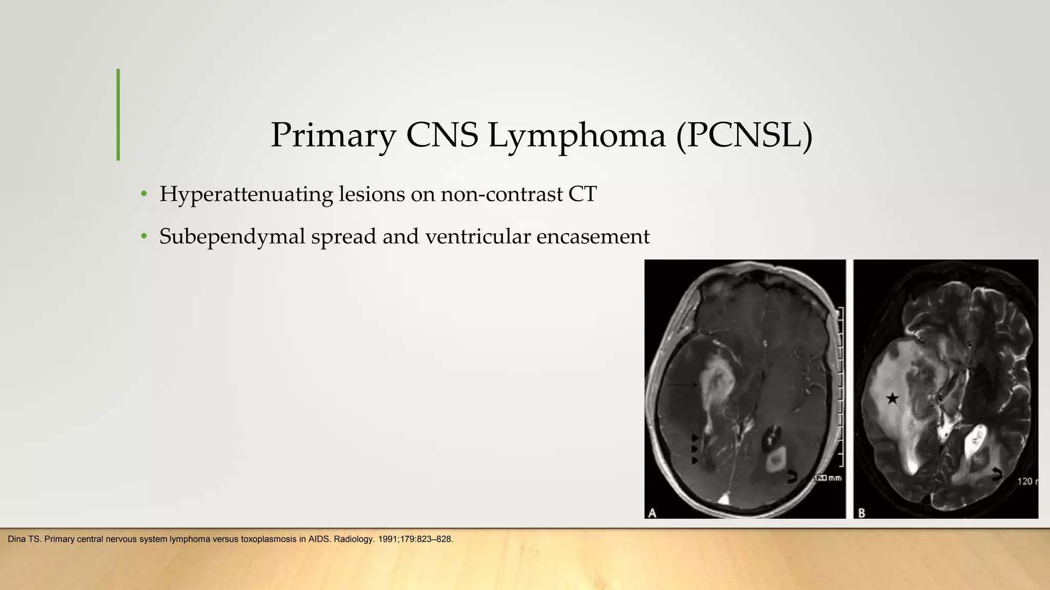 Primary CNS Lymphoma (PCNSL)
• Hyperattenuating lesions on non-contrast CT
• Subependymal spread and ventricular encasement
Dina TS. Primary central nervous system lymphoma versus toxoplasmosis in AIDS. Radiology. 1991;179:823–828.
 