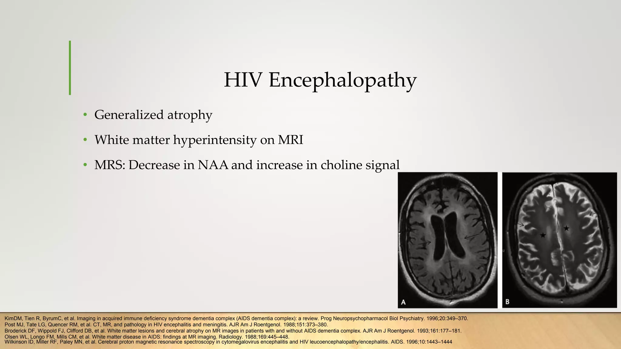 HIV Encephalopathy
• Generalized atrophy
• White matter hyperintensity on MRI
• MRS: Decrease in NAA and increase in choline signal
KimDM, Tien R, ByrumC, et al. Imaging in acquired immune deficiency syndrome dementia complex (AIDS dementia complex): a review. Prog Neuropsychopharmacol Biol Psychiatry. 1996;20:349–370.
Post MJ, Tate LG, Quencer RM, et al. CT, MR, and pathology in HIV encephalitis and meningitis. AJR Am J Roentgenol. 1988;151:373–380.
Broderick DF, Wippold FJ, Clifford DB, et al. White matter lesions and cerebral atrophy on MR images in patients with and without AIDS dementia complex. AJR Am J Roentgenol. 1993;161:177–181.
Olsen WL, Longo FM, Mills CM, et al. White matter disease in AIDS: findings at MR imaging. Radiology. 1988;169:445–448.
Wilkinson ID, Miller RF, Paley MN, et al. Cerebral proton magnetic resonance spectroscopy in cytomegalovirus encephalitis and HIV leucoencephalopathy/encephalitis. AIDS. 1996;10:1443–1444
 