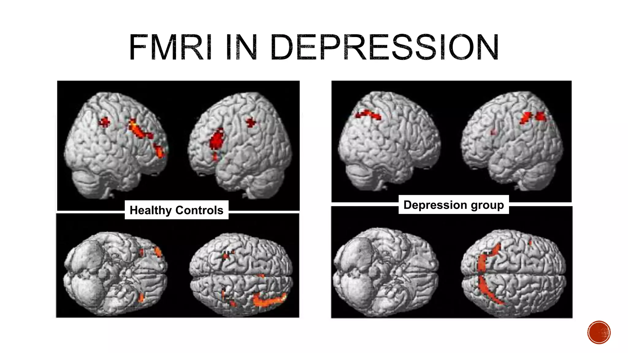 Depression groupHealthy Controls
 