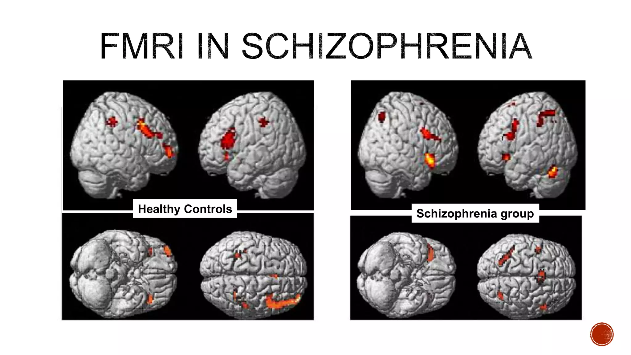 Schizophrenia groupHealthy Controls
 