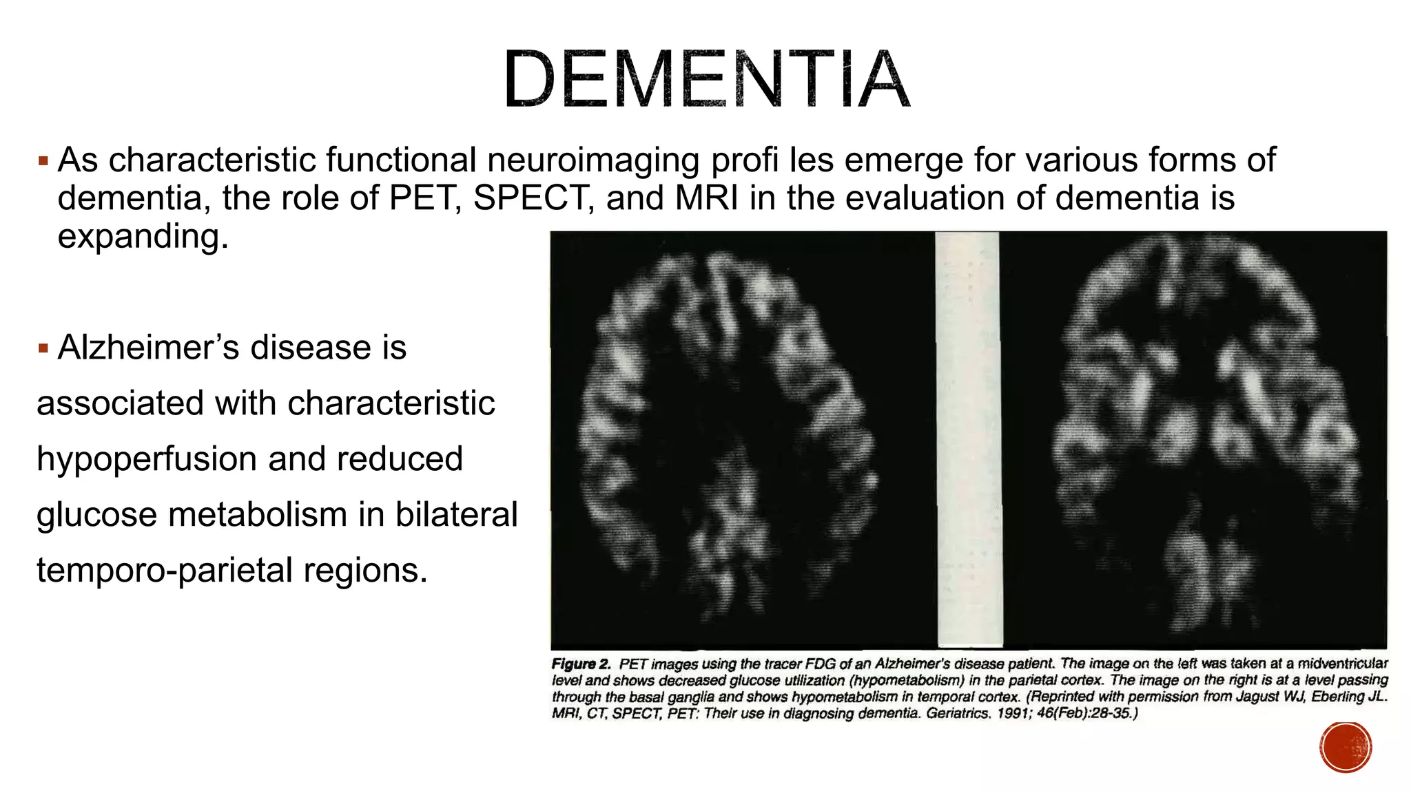  As characteristic functional neuroimaging profi les emerge for various forms of
dementia, the role of PET, SPECT, and MRI in the evaluation of dementia is
expanding.
 Alzheimer’s disease is
associated with characteristic
hypoperfusion and reduced
glucose metabolism in bilateral
temporo-parietal regions.
 