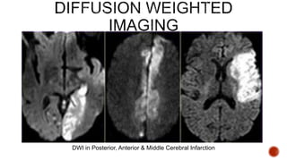 DWI in Posterior, Anterior & Middle Cerebral Infarction
 
