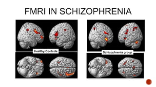 Schizophrenia groupHealthy Controls
 