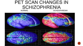 NORMAL SCHIZOPHRENIA
 