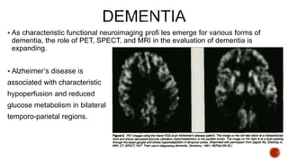  As characteristic functional neuroimaging profi les emerge for various forms of
dementia, the role of PET, SPECT, and MRI in the evaluation of dementia is
expanding.
 Alzheimer’s disease is
associated with characteristic
hypoperfusion and reduced
glucose metabolism in bilateral
temporo-parietal regions.
 