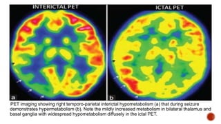 PET imaging showing right temporo-parietal interictal hypometabolism (a) that during seizure
demonstrates hypermetabolism (b). Note the mildly increased metabolism in bilateral thalamus and
basal ganglia with widespread hypometabolism diffusely in the ictal PET.
 