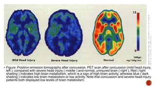  Figure: Positron emission tomography after concussion. PET scan after concussion (mild head injury,
left ), compared with severe head injury ( middle ) and normal, uninjured brain ( right ). Red ( light
shading ) indicates high brain metabolism, which is a sign of high brain activity, whereas blue ( dark
shading ) indicates low brain metabolism or low activity. Note that concussion and severe head-injury
patients both displayed low levels of brain metabolism.
 