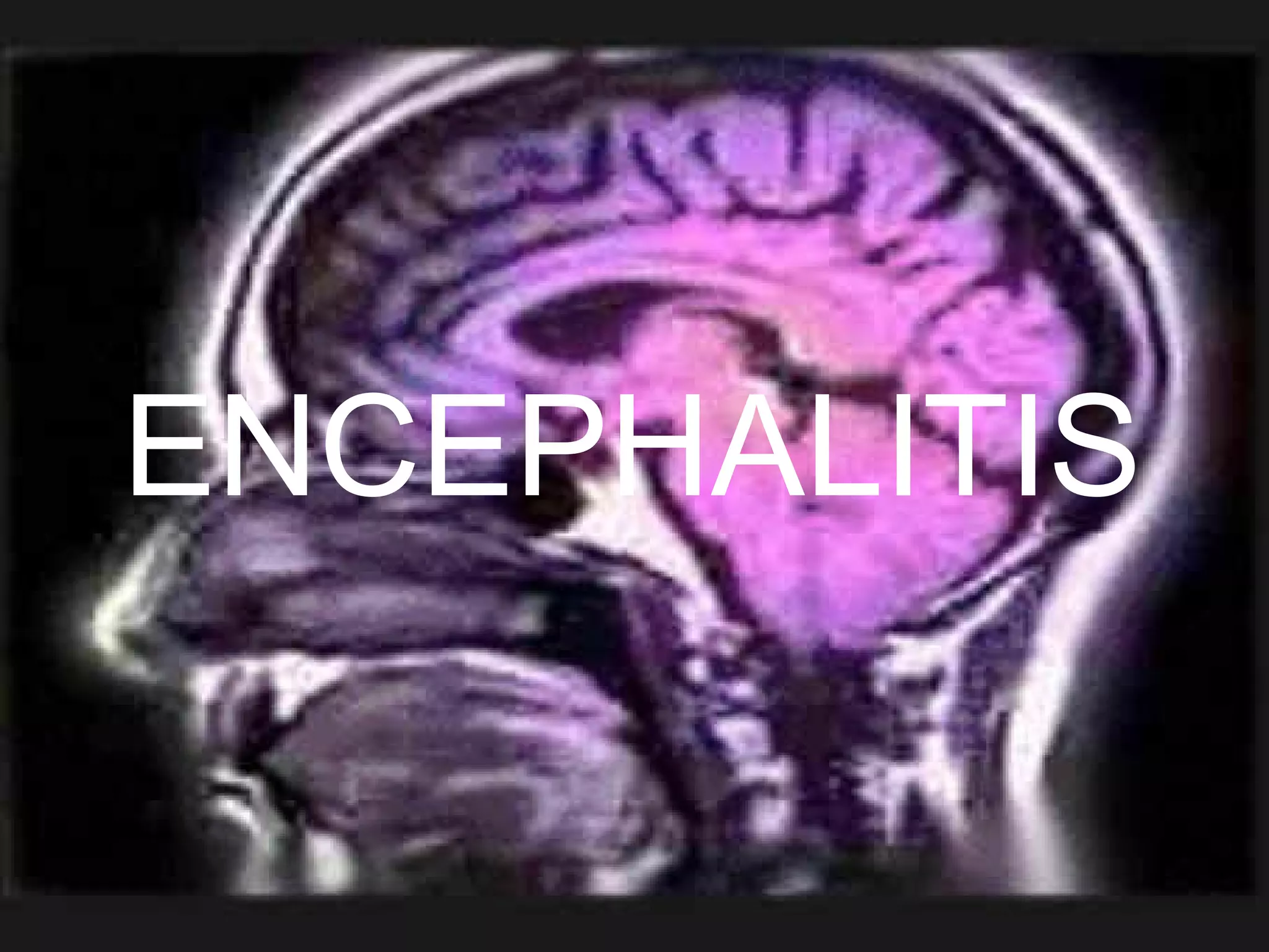 ENCEPHALITIS 