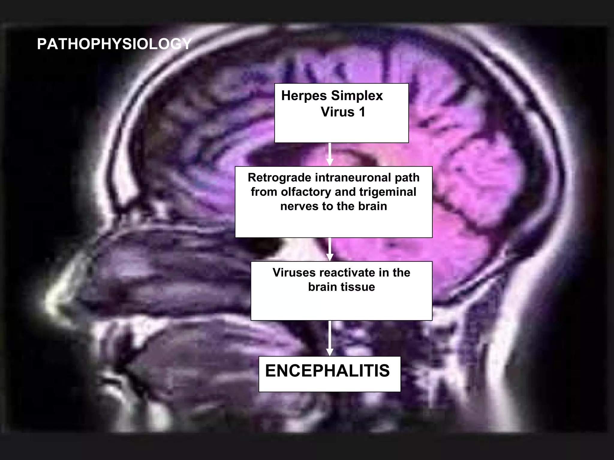 PATHOPHYSIOLOGY Herpes Simplex  Virus 1 Retrograde intraneuronal path from olfactory and trigeminal nerves to the brain Viruses reactivate in the brain tissue ENCEPHALITIS 