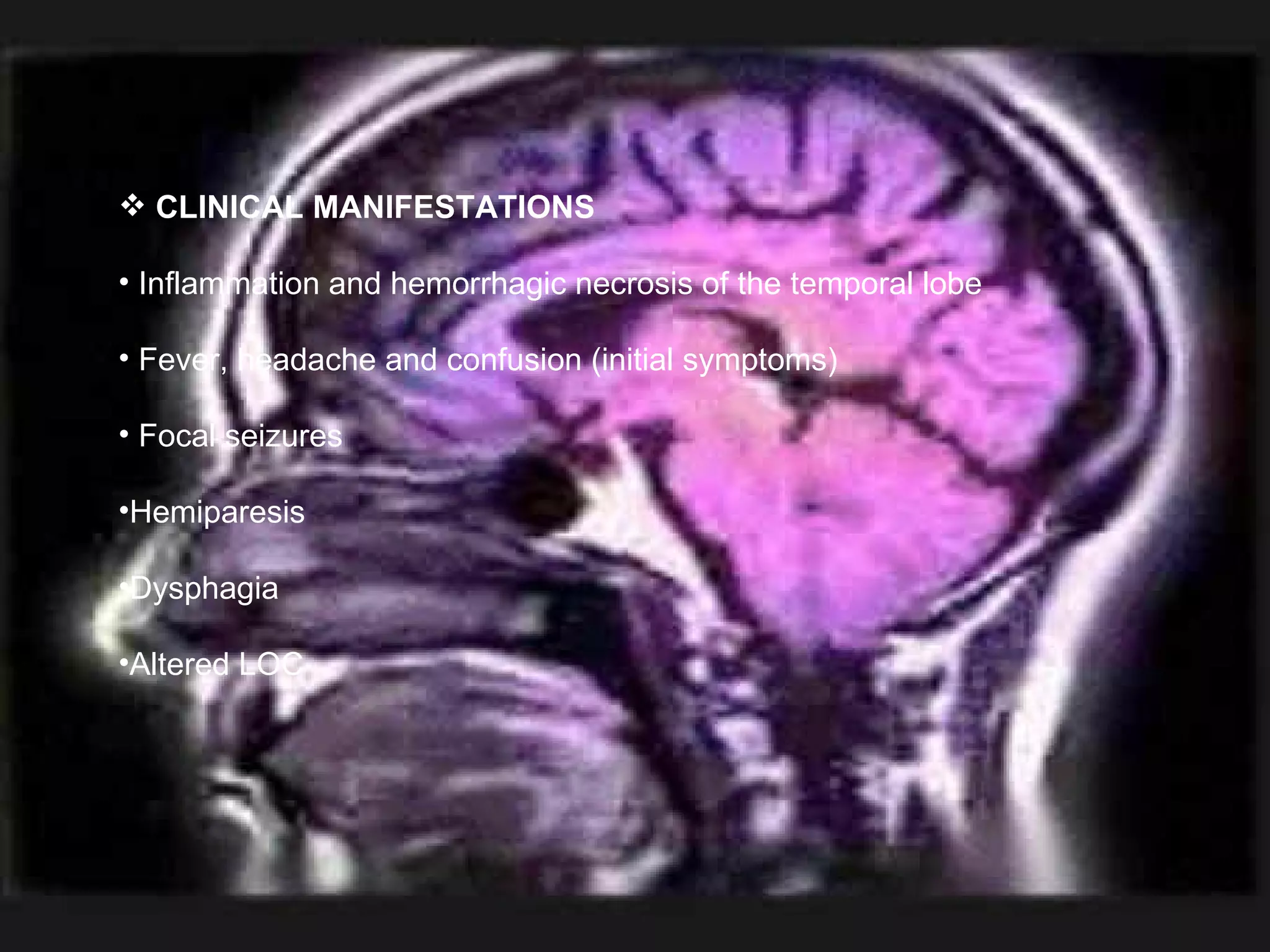 CLINICAL MANIFESTATIONS Inflammation and hemorrhagic necrosis of the temporal lobe Fever, headache and confusion (initial symptoms) Focal seizures Hemiparesis Dysphagia Altered LOC 