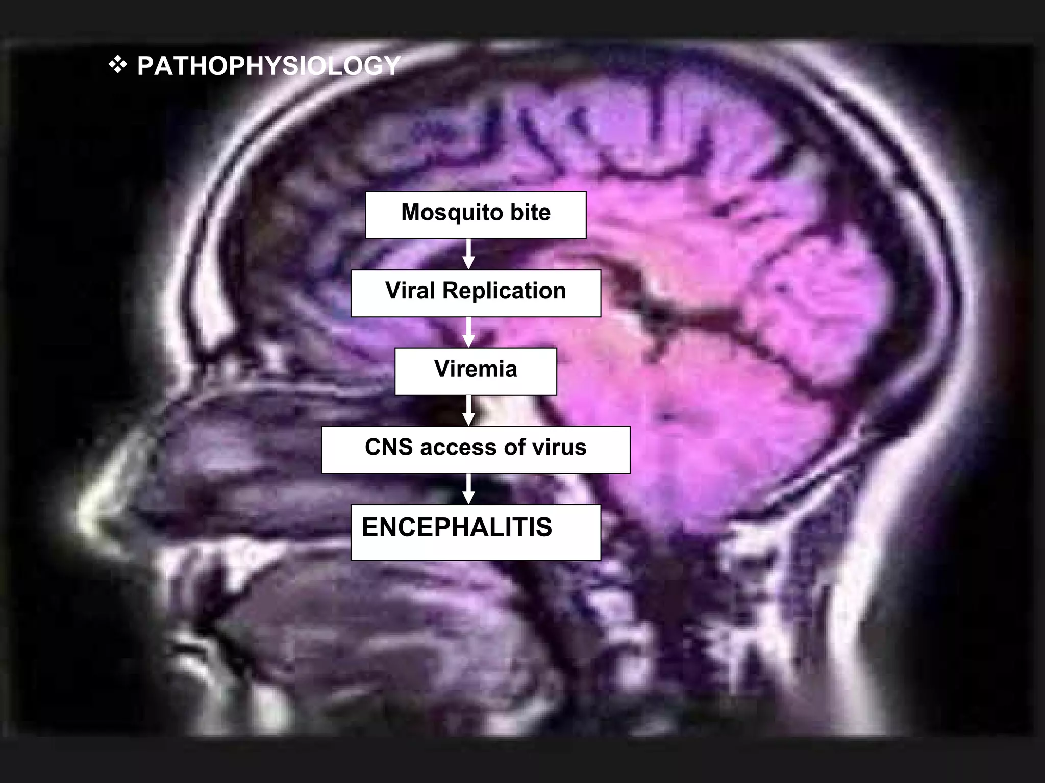 PATHOPHYSIOLOGY Mosquito bite Viral Replication Viremia CNS access of virus ENCEPHALITIS 