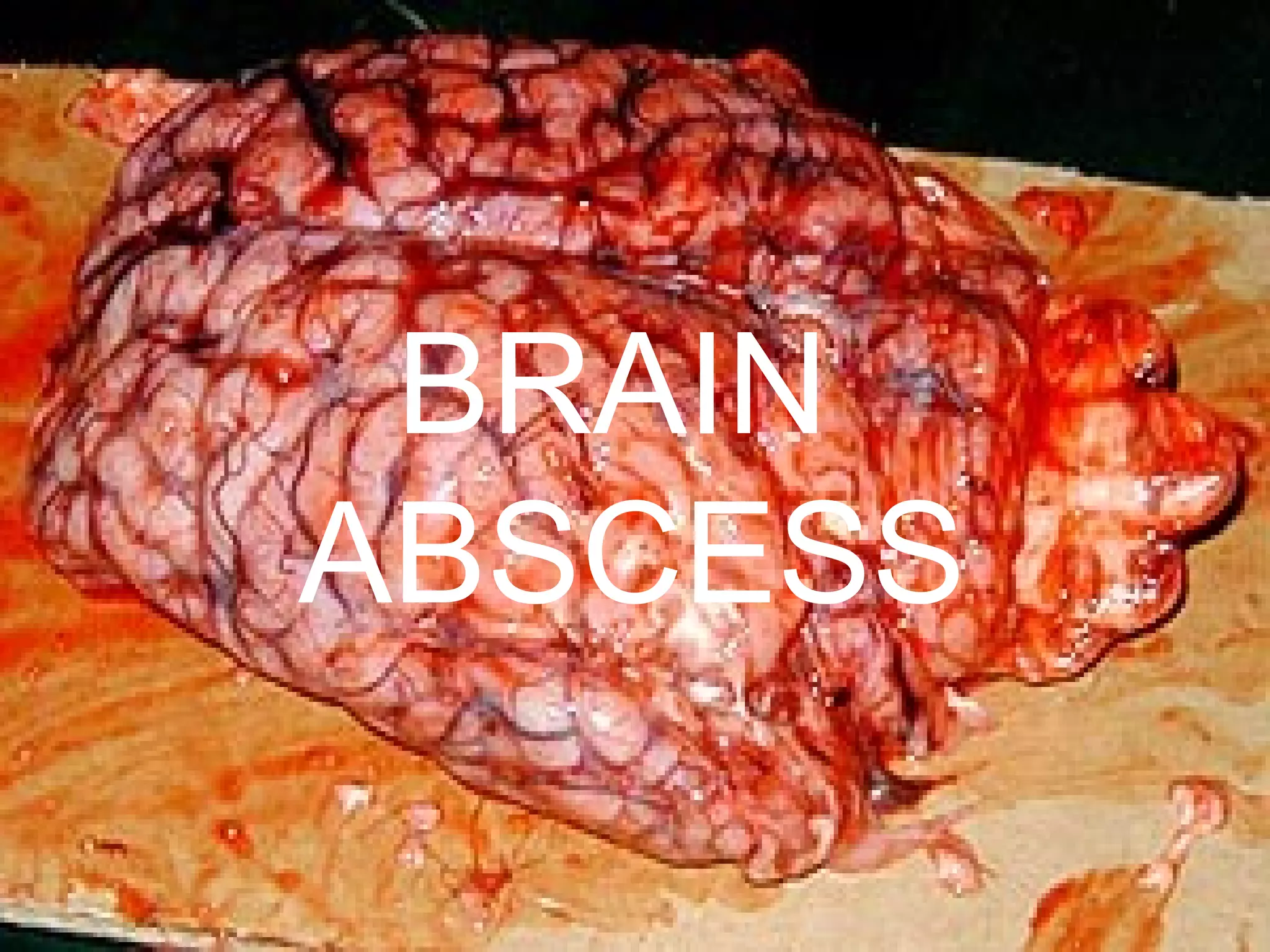 BRAIN  ABSCESS 