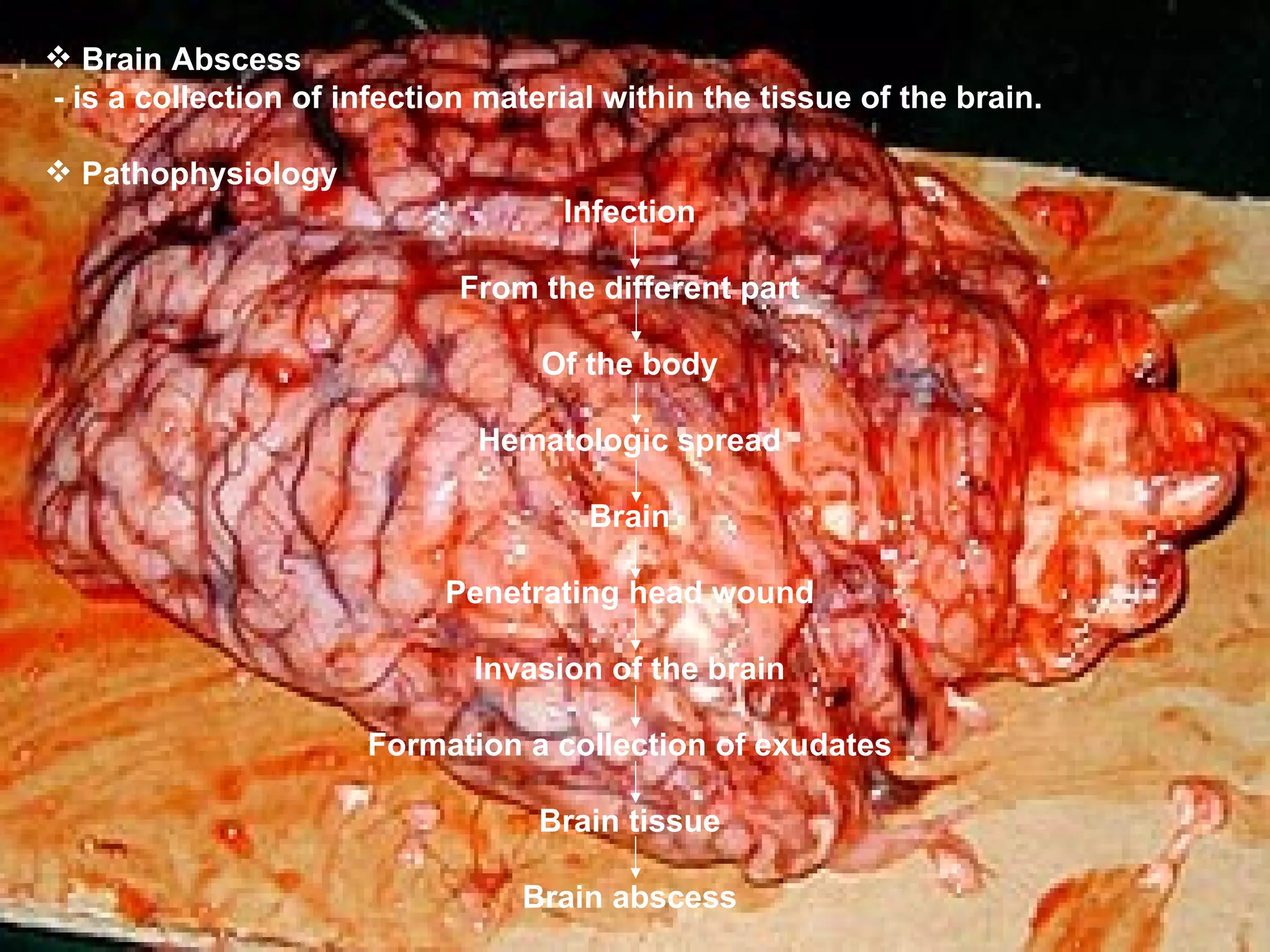 Brain Abscess - is a collection of infection material within the tissue of the brain. Pathophysiology Infection From the different part Of the body Hematologic spread Brain Penetrating head wound Invasion of the brain Formation a collection of exudates Brain tissue Brain abscess 