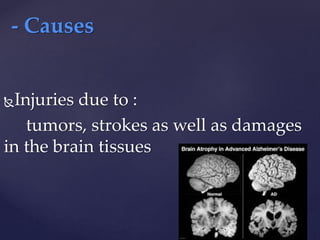 Injuries due to :
tumors, strokes as well as damages
in the brain tissues
- Causes
 