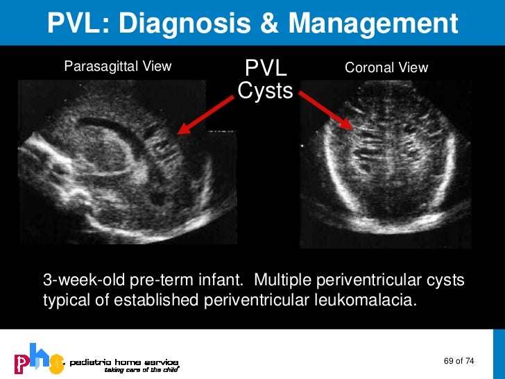 Brain Injury in Pre-Term Infants