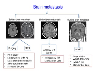 Solitary brain metastasis Multiple brain metastasisLimited brain metastasis
Brain metastasis
Surgery SRS WBRT
?
Surgery/ SRS
WBRT
• Ph III study
• Solitary mets with no
Extra cranial site disease
• 2 mo survival benefit
• Standard of Care
• Large series
• WBRT-30Gy/10#
• MS 6-9 mo
• Standard of Care
• Till recently NO
Standard of Care
 