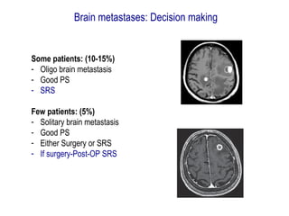 Some patients: (10-15%)
- Oligo brain metastasis
- Good PS
- SRS
Few patients: (5%)
- Solitary brain metastasis
- Good PS
- Either Surgery or SRS
- If surgery-Post-OP SRS
Brain metastases: Decision making
 