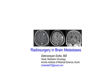 Debnarayan Dutta, MD
Head, Radiation Oncology
Amrita Institute of Medical Science, Kochi
duttadeb07@gmail.com
Radiosurgery in Brain Metastases
 