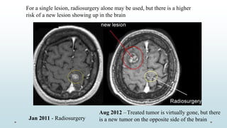 For a single lesion, radiosurgery alone may be used, but there is a higher
risk of a new lesion showing up in the brain
Aug 2012 –Treated tumor is virtually gone, but there
is a new tumor on the opposite side of the brainJan 2011 - Radiosurgery
 