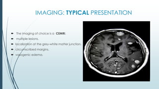 IMAGING: TYPICAL PRESENTATION
 The imaging of choice is a CEMRI.
 multiple lesions.
 localization at the grey-white matter junction.
 circumscribed margins.
 vasogenic edema.
 