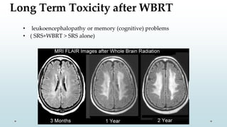 Long Term Toxicity after WBRT
• leukoencephalopathy or memory (cognitive) problems
• ( SRS+WBRT > SRS alone)
 