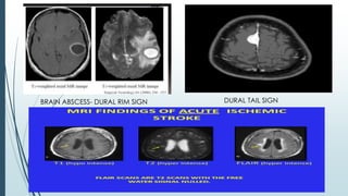 BRAIN ABSCESS- DURAL RIM SIGN DURAL TAIL SIGN
 