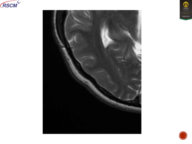 Brain MRI.pptx adalah memberikan gambaran MRI | PPTX