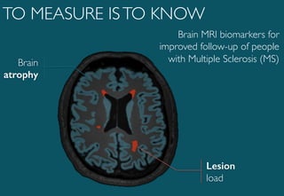 Brain
atrophy!
Lesion !
load
TO MEASURE ISTO KNOW
Brain MRI biomarkers for
improved follow-up of people
with Multiple Sclerosis (MS)
 