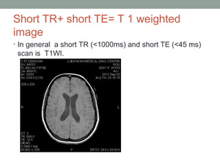 Short TR+ short TE= T 1 weighted
image
• In general a short TR (<1000ms) and short TE (<45 ms)
scan is T1WI.
 