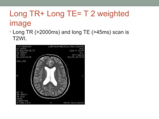 Long TR+ Long TE= T 2 weighted
image
• Long TR (>2000ms) and long TE (>45ms) scan is
T2WI.
 