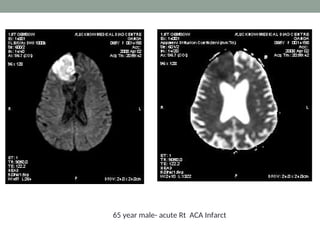 65 year male- acute Rt ACA Infarct
 