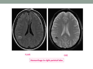 GRE
FLAIR
Hemorrhage in right parietal lobe
 