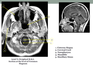 1
2
3
4
5
Axial T1 Weighted M.R.I.
Section at the level of Foramen
Magnum
1. Cisterna Magna
2. Cervical Cord
3. Nasopharynx
4. Mandible
5. Maxillary Sinus
 
