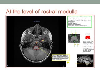 At the level of rostral medulla
 