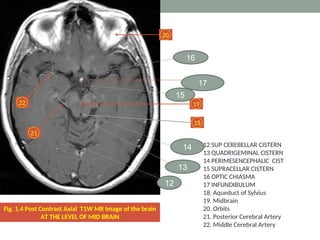 Fig. 1.4 Post Contrast Axial T1W MR Image of the brain
AT THE LEVEL OF MID BRAIN
18
19
20
21
22
12 SUP CEREBELLAR CISTERN
13 QUADRIGEMINAL CISTERN
14 PERIMESENCEPHALIC CIST
15 SUPRACELLAR CISTERN
16 OPTIC CHIASMA
17 INFUNDIBULUM
18. Aqueduct of Sylvius
19. Midbrain
20. Orbits
21. Posterior Cerebral Artery
22. Middle Cerebral Artery
17
16
15
12
13
14
 