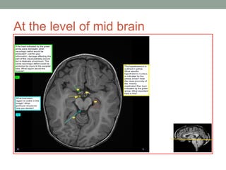 At the level of mid brain
 