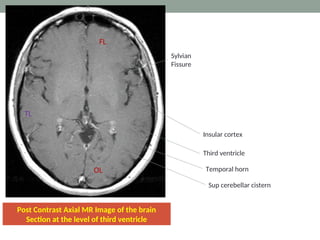 Post Contrast Axial MR Image of the brain
Section at the level of third ventricle
TL
FL
OL
Sylvian
Fissure
Temporal horn
Sup cerebellar cistern
Insular cortex
Third ventricle
 