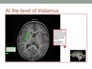 At the level of thalamus
 