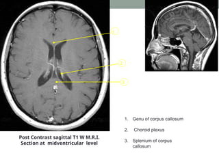 3
2
1
Post Contrast sagittal T1 W M.R.I.
Section at midventricular level
1. Genu of corpus callosum
2. Choroid plexus
3. Splenium of corpus
callosum
 