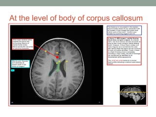At the level of body of corpus callosum
 