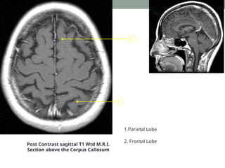 1
2
Post Contrast sagittal T1 Wtd M.R.I.
Section above the Corpus Callosum
1.Parietal Lobe
2. Frontal Lobe
 