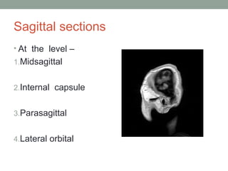 Sagittal sections
• At the level –
1.Midsagittal
2.Internal capsule
3.Parasagittal
4.Lateral orbital
 