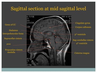 Sagittal section at mid sagittal level
pons
medulla
4th
ventricle
thalamus
3rd
ventricle
Corpus callosum
Sup cerebellar cistern
Cisterna magna
Prepontine cistern
Interpeduncular fossa
Supracellar cistern
Genu of CC
Cingulate gyrus
 