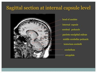 cerebral peduncle
head of caudate
middle cerebellar peduncle
tentorium cerebelli
Sagittal section at internal capsule level
parieto occipital sulcus
Internal capsule
cerebellum
amygdala
 