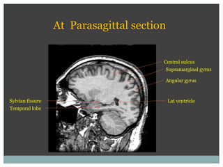 Central sulcus
Lat ventricle
Temporal lobe
Sylvian fissure
At Parasagittal section
Supramarginal gyrus
Angular gyrus
 