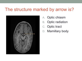 The structure marked by arrow is?
A. Optic chiasm
B. Optic radiation
C. Optic tract
D. Mamillary body
 